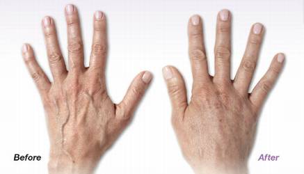 radiesse hands medical cosmetic Washington Dc & Virginia radiesse hands medical cosmetic Washington Dc & Virginia